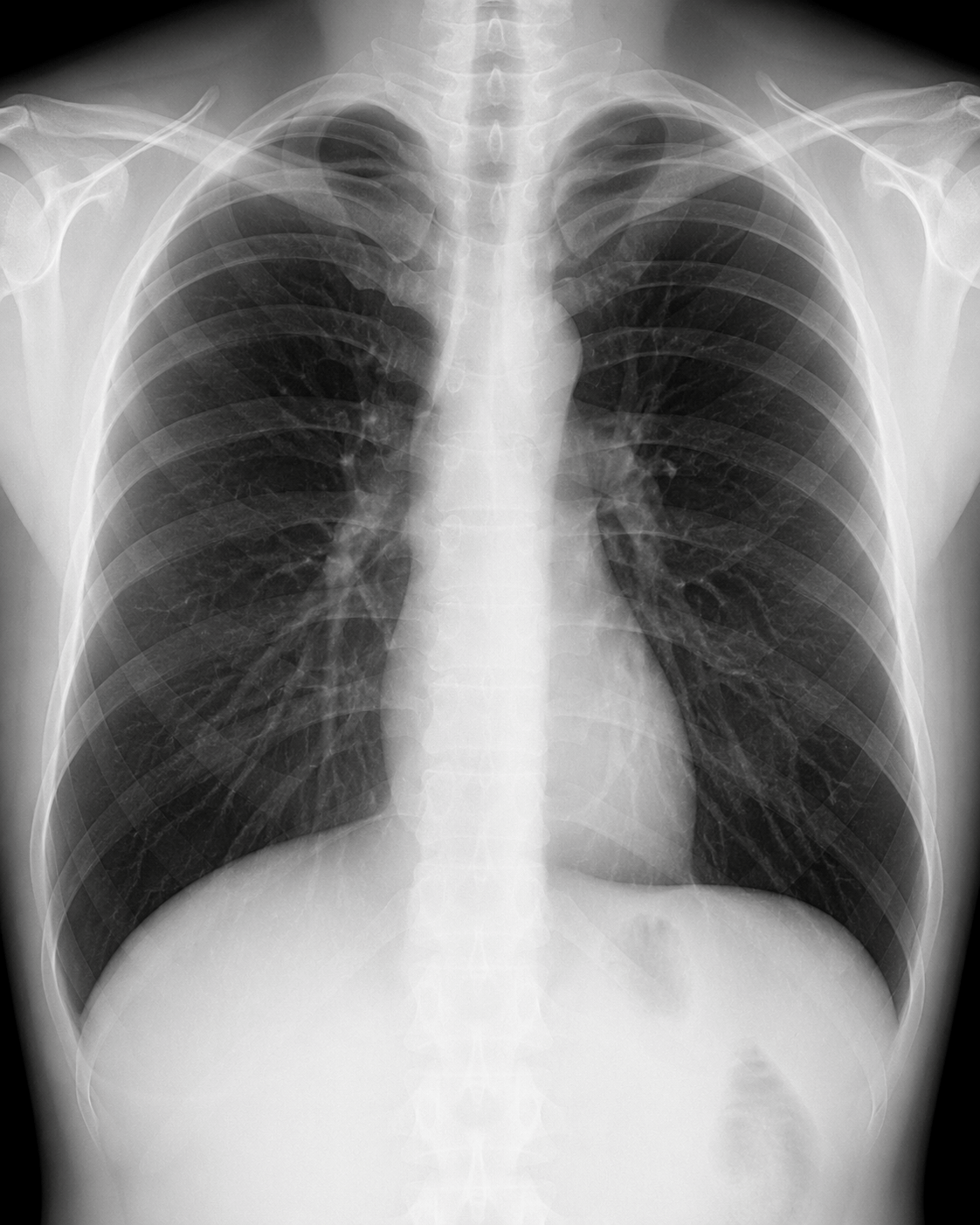 胸部X線検査イメージ