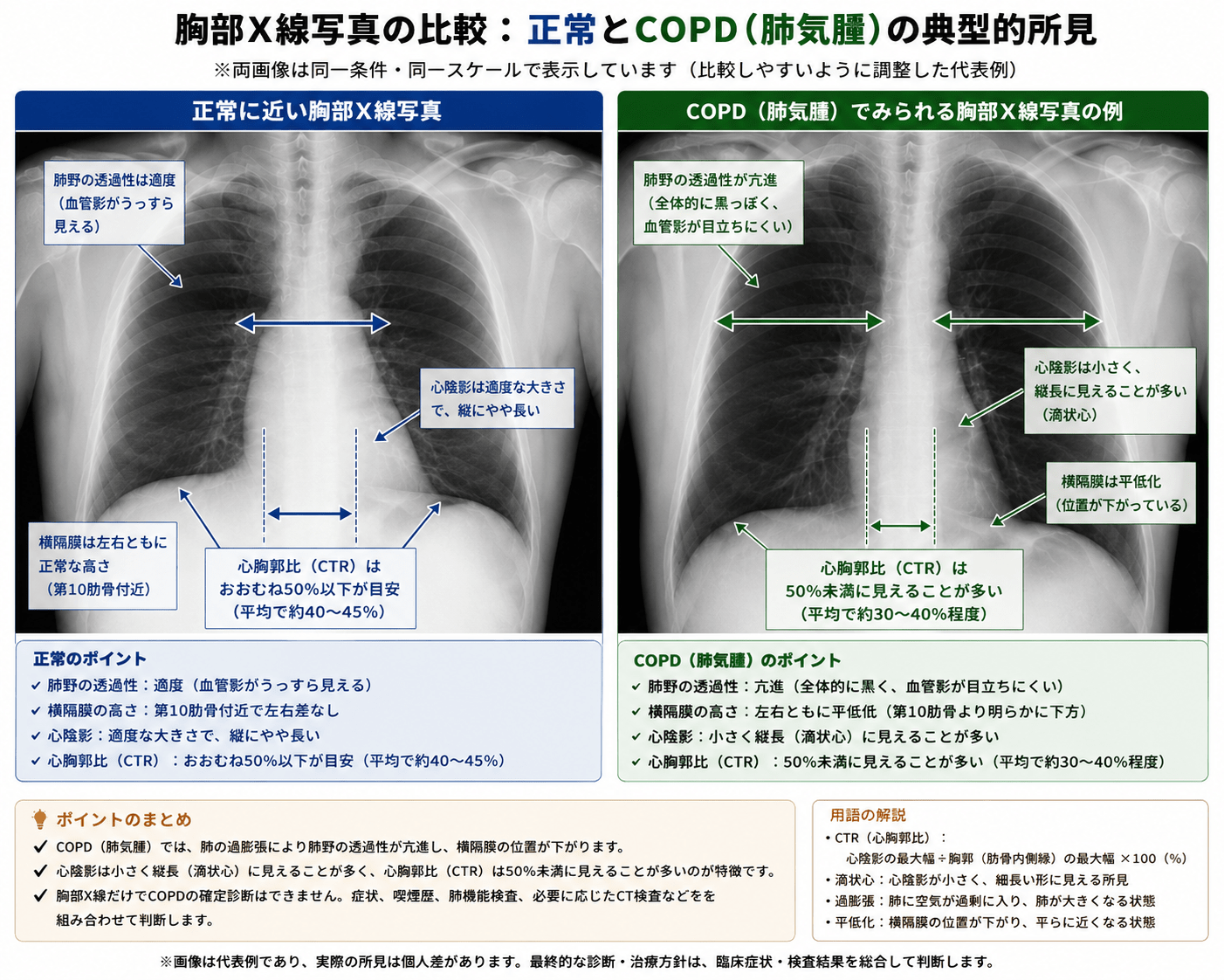 正常に近い胸部X線写真とCOPD・肺気腫でみられる胸部X線所見の比較図